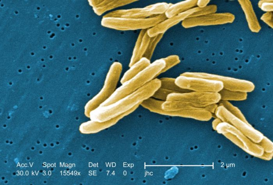  Debatirán especialistas situación actual, manejo y tratamiento de la tuberculosis en México